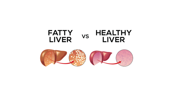 What should you know about Fatty Liver Disease?